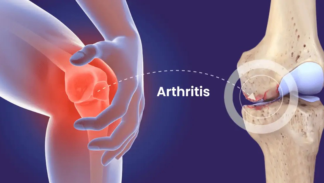 The Role of Pain Management in Arthritis: Medications and&nbsp;Beyond